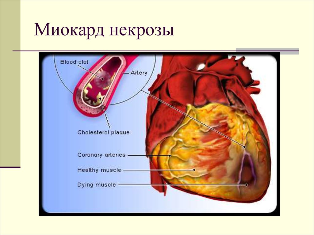 Миокард инфарктісі презентация