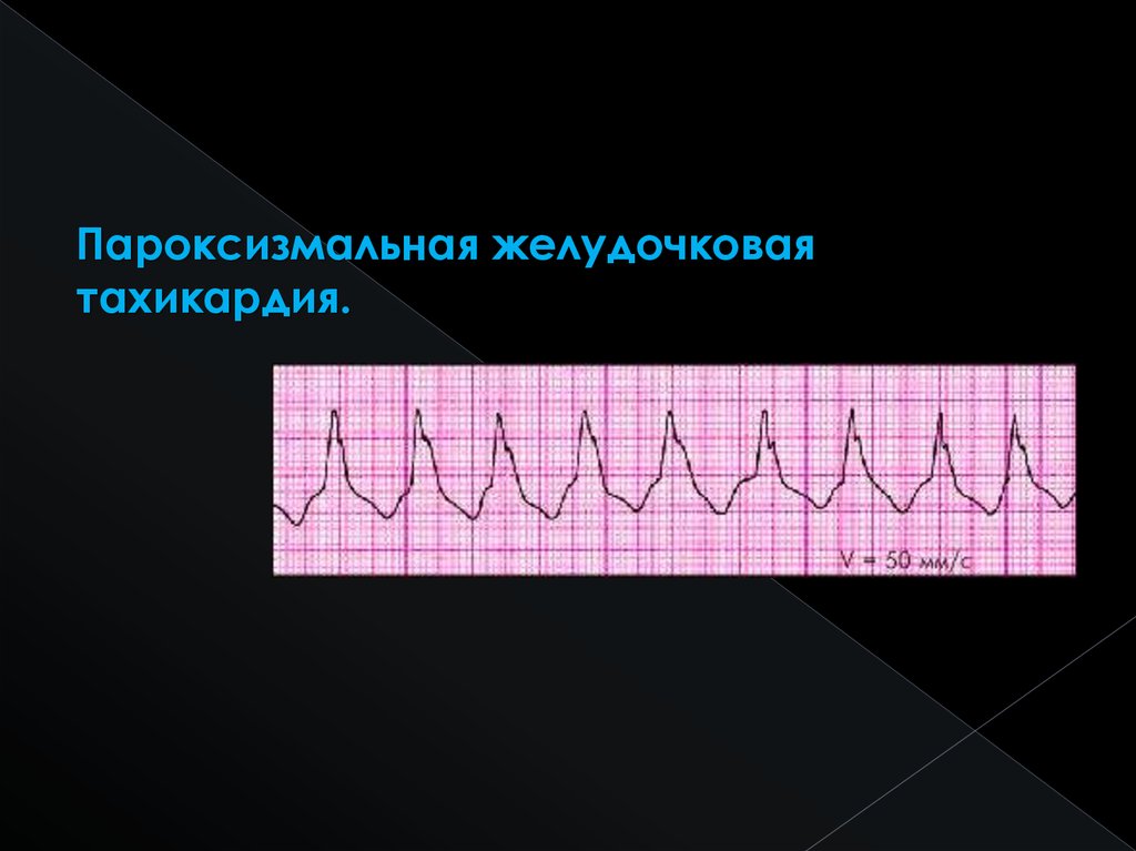 Пароксизмальная тахикардия презентация