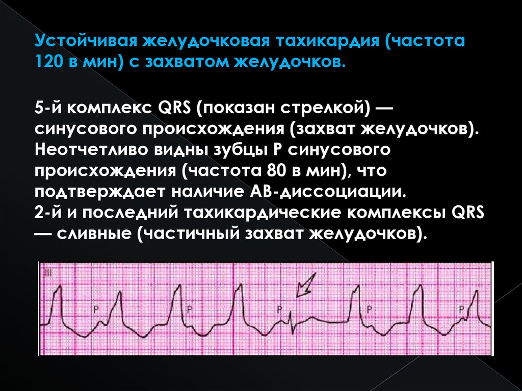 Желудочковые тахикардии презентация