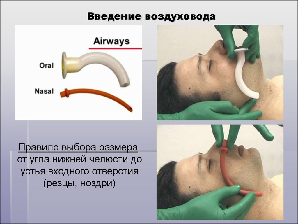 Техника рот. Техника введения воздуховода. Введение воздуховода алгоритм. Введение s образного воздуховода.