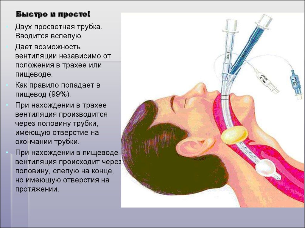 Трубка через рот. Интубационная трубка ИВЛ. Анестезия: эндотрахеальный наркоз.. Интубация трахеи эндотрахеальной трубкой.