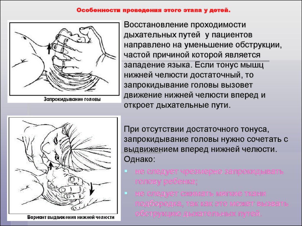 Проведение проходимости дыхательных путей. Этапы восстановления проходимости дыхательных путей. Восстановление проходимости дыхательных путей у детей. Особенности проходимости дыхательных путей у детей. Восстановление проходимости дых путей при западении языка.