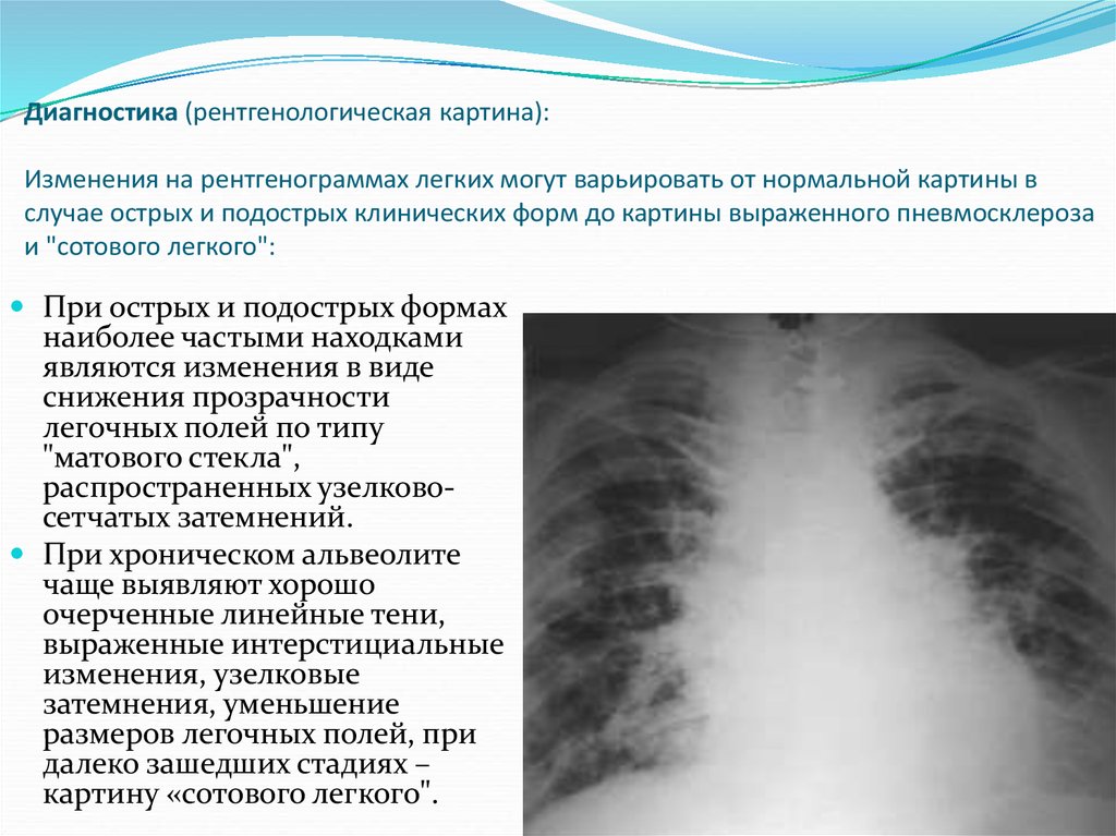 Легочный рисунок с признаками пневмосклероза что это значит