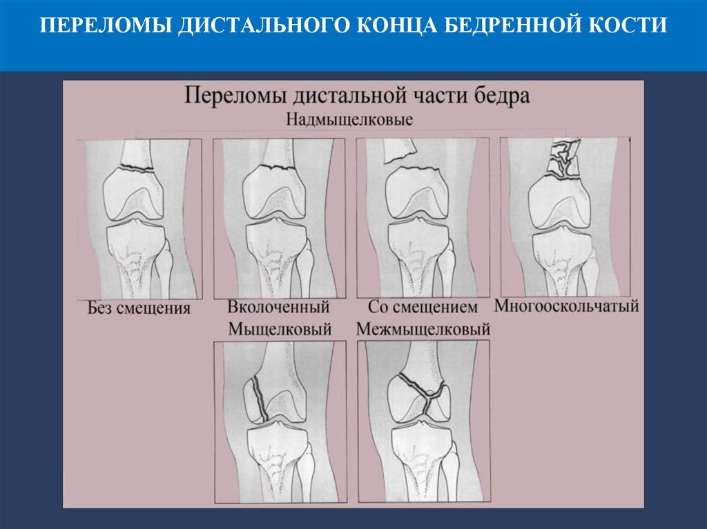 Дистальные переломы бедренной кости. Классификация переломов дистального метаэпифиза бедренной кости. Перелом дистального отдела бедренной кости классификация. Классификация переломов дистального сегмента бедренной кости. Переломы дистального отдела бедра классификация.