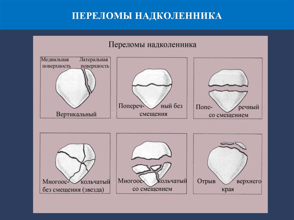 Латеральная фасетка