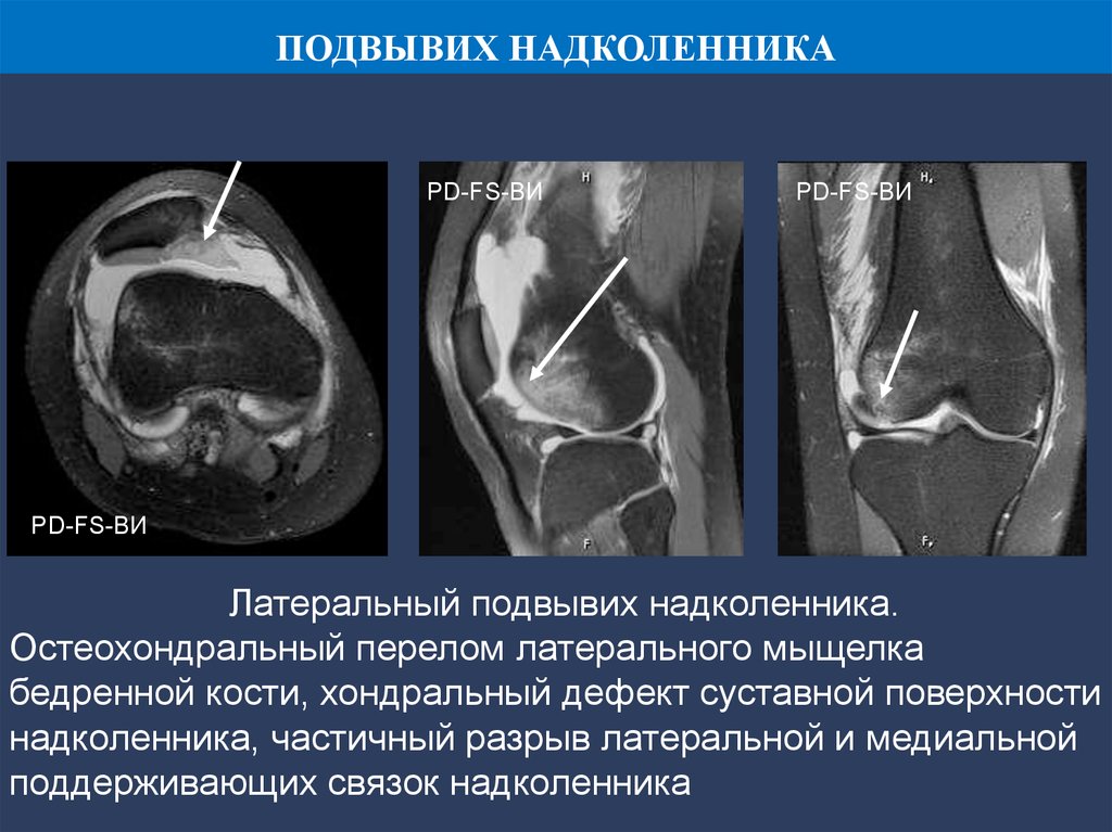 Вывих надколенника карта вызова