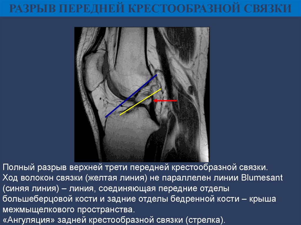 Мр признаки разрыва. Разрыв волокон передней крестообразной связки коленного сустава. Разрыв задней крестообразной связки коленного сустава мрт. ПКС (передняя крестообразная связка). Задняя крестообразная связка мрт.
