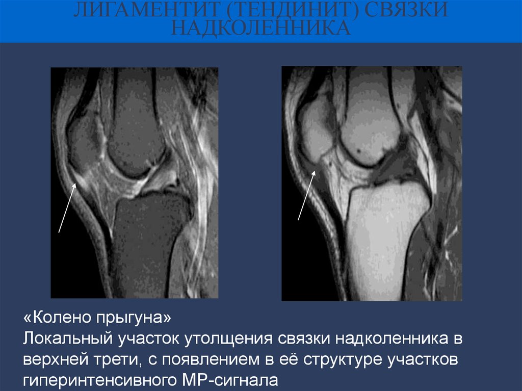 Тендинит коленных связок. Тендиноз сухожилия надколенника. Тендинопатия связки надколенника. Лигаментит коленного сустава рентген. Тендинит коленного сустава на мрт.
