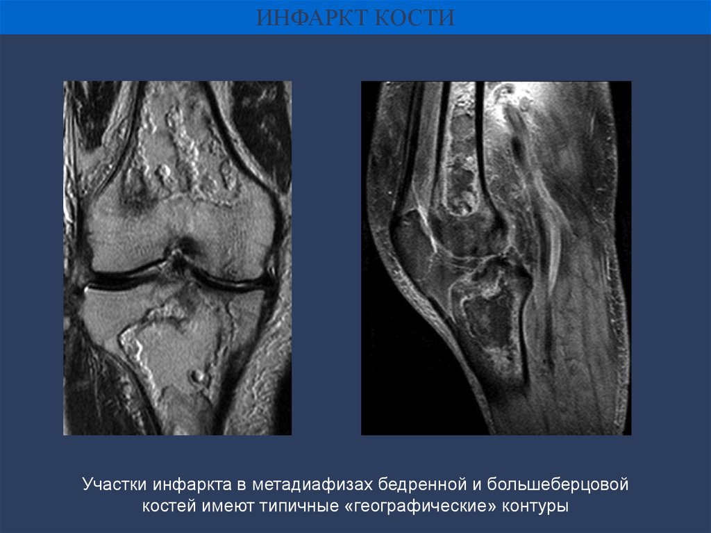 Изменения костного мозга мрт