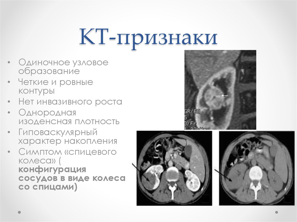 Образование почки. Гиперденсные образования почек на кт. Гиперденсивные образования в почках на кт.