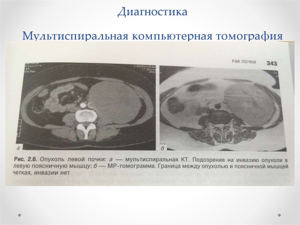 Шаблоны описания кт. Мультиспиральная кт почек опухоль. Опухоль почки на компьютерной томографии. Объемные образования почек кт.