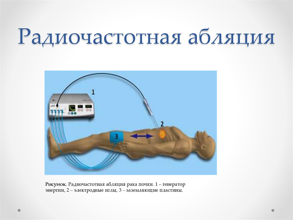 Радиочастотная термоабляция. Радиочастотная катетерная абляция. Радииочастотная абляция почк. Радиочастотная абляция почки.