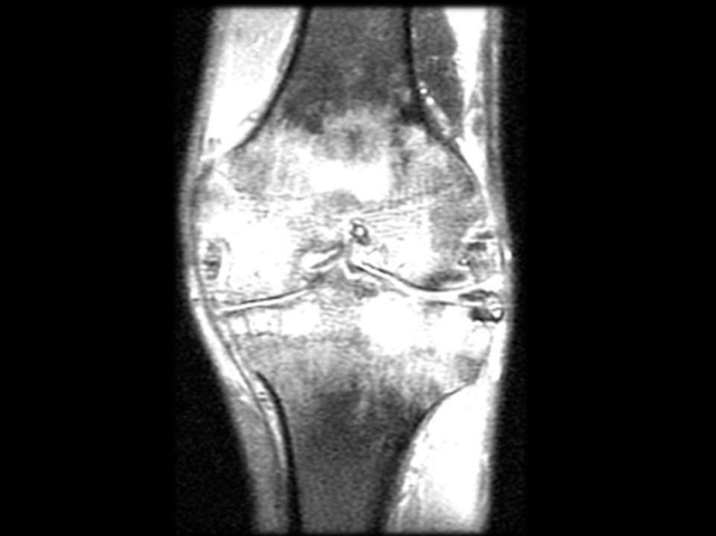Мрт суставов. Остеоартроз коленного сустава мрт. Ревматоидный артрит коленного сустава мрт. Ревматоидный артрит на мрт колена. Артропатия коленных суставов на мрт.