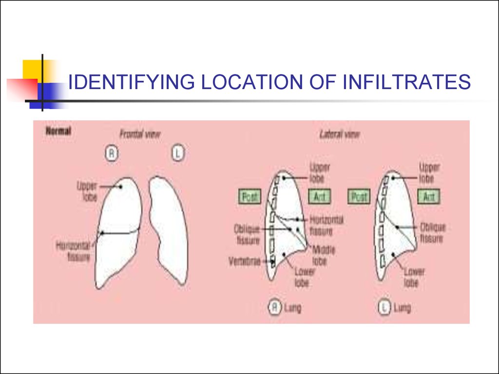 IDENTIFYING LOCATION OF INFILTRATES