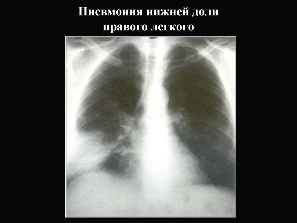 Поражения правого легкого. Внебольничная пневмония нижней доли правого легкого рентген. Очаговая пневмония нижней доли правого легкого. Правосторонняя очаговая пневмония рентген. Пневмония нижней доли рентген.