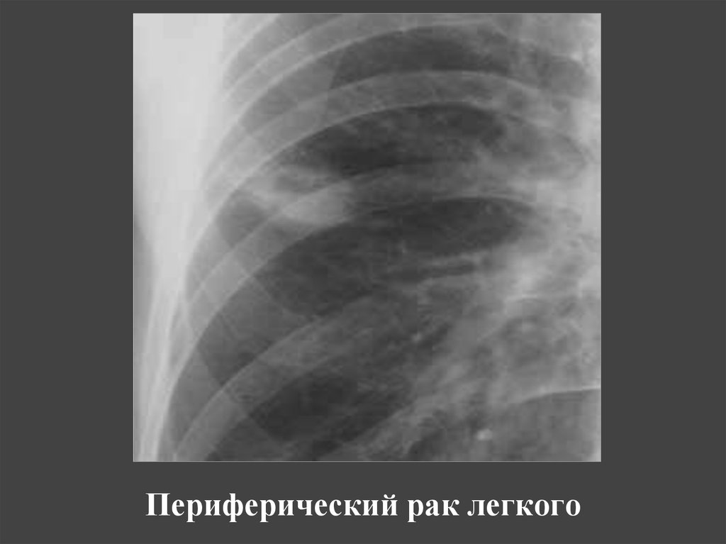 Периферический рак. Периферический тумор правого легкого. Периферический tumor легкого17милиметров. Периферическая опухоль легкого. Периферический са правого легкого.