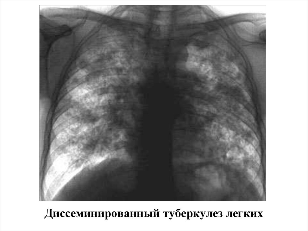 Диссеминированный туберкулез легких