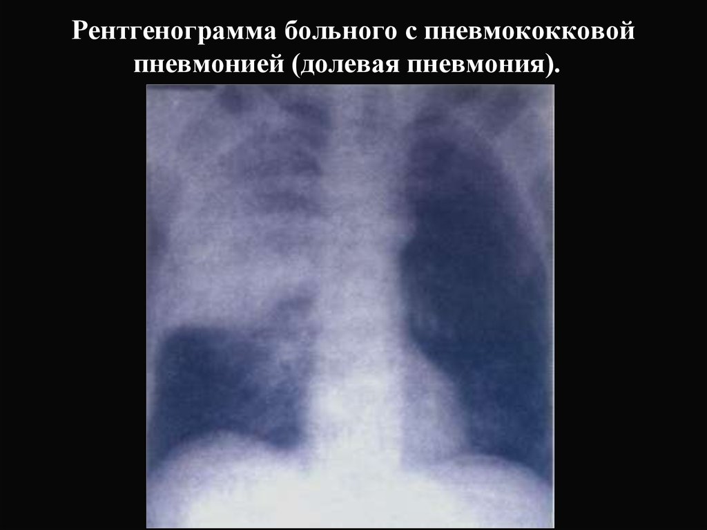 Рентгенограмма больного с пневмококковой пневмонией (долевая пневмония).  