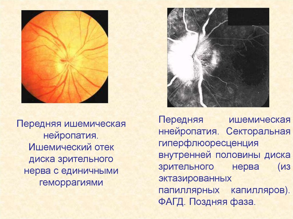 Передняя ишемическая нейропатия. Передняя ишемическая оптиконейропатия зрительный нерв. Нейрооптикопатия зрительного нерва. Ишемический неврит зрительного нерва.