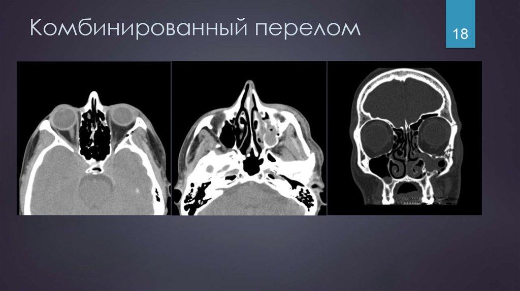 Комбинированные повреждения чло презентация