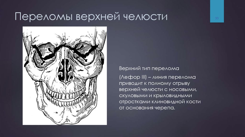 Переломы челюстей презентация