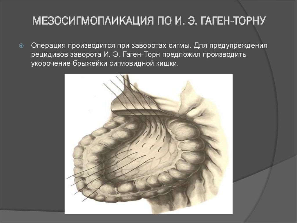 Гаген торн. Гаген Торну это мезосигмопликация. Операция по Гаген Торну. Мезосигмопликация по Гаген-Торну при завороте. Брыжейка сигмовидной кишки.