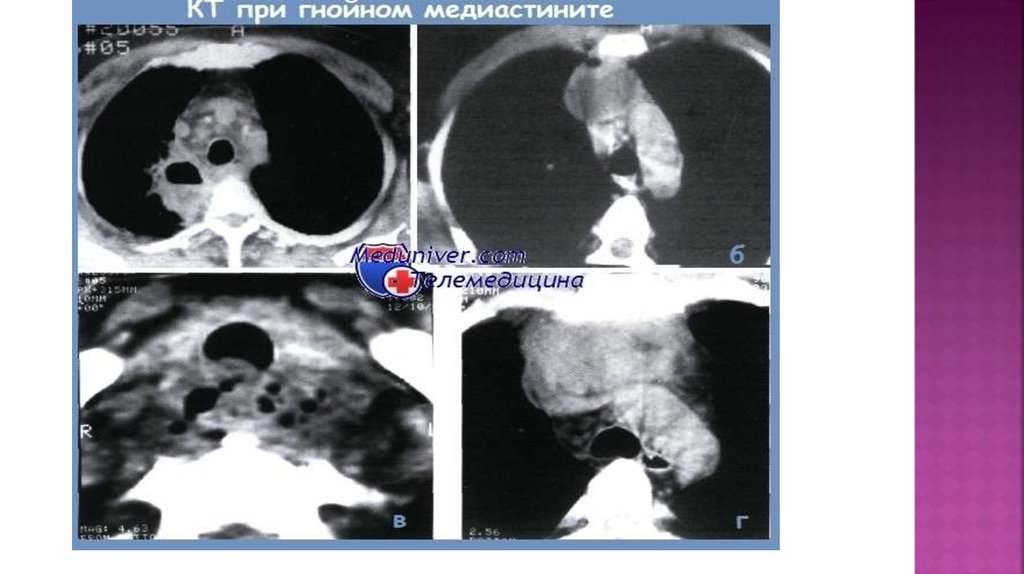 Медиастинит причины. Медиастинит причины