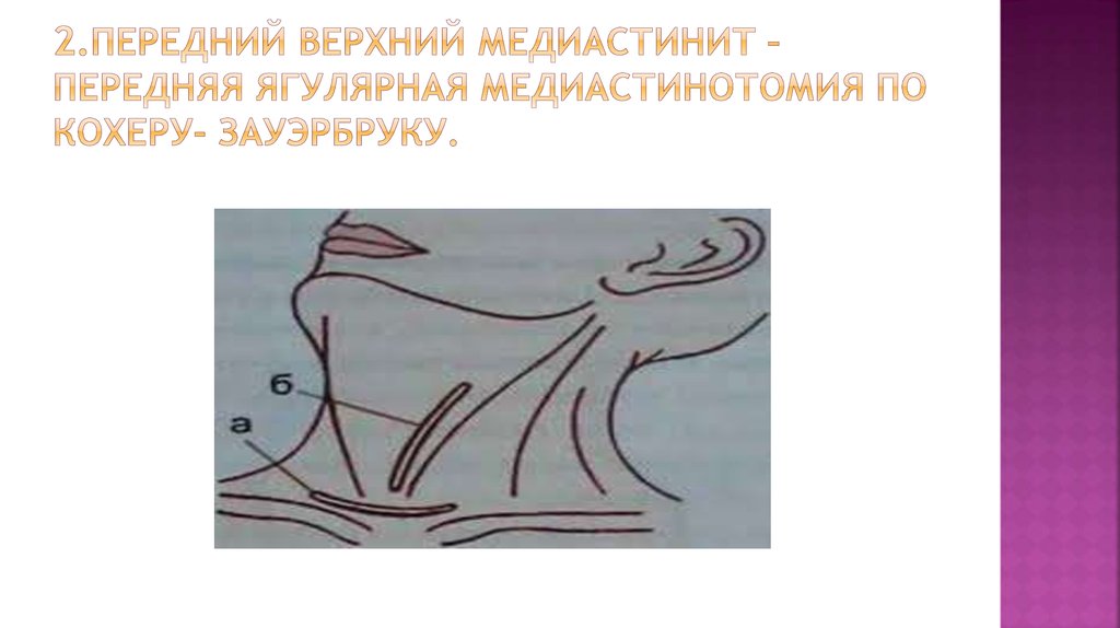 2.Передний верхний медиастинит – передняя ягулярная медиастинотомия по Кохеру- Зауэрбруку.