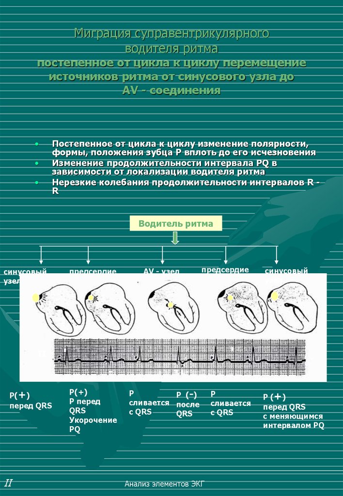 Миграция водителя ритма код. Миграция суправентрикулярного ритма. Миграция суправентрикулярного водителя ритма. Синусовый ритм миграция водителя. Миграция водителя ритма от синусового узла.