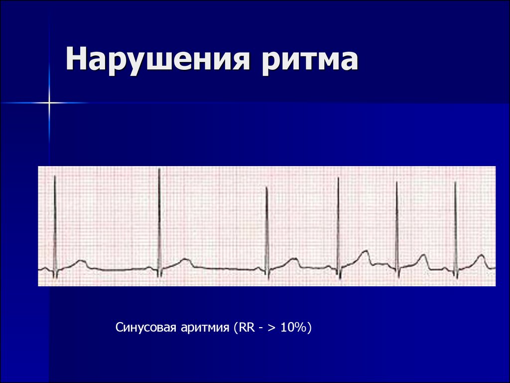 Сбой ритма. Ритм синусовая аритмия. Синусовый ритм и синусовая аритмия. Синусовый ритм сердца и аритмия. Нарушение синусового ритма сердца что это.