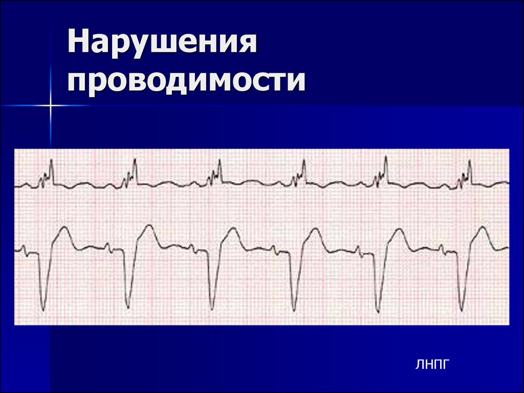 Нарушение проводимости на экг. ЭКГ нарушения ритма и проводимости. ЭКГ при нарушениях ритма и проводимости. Нарушение сердечного ритма и проводимости на ЭКГ.