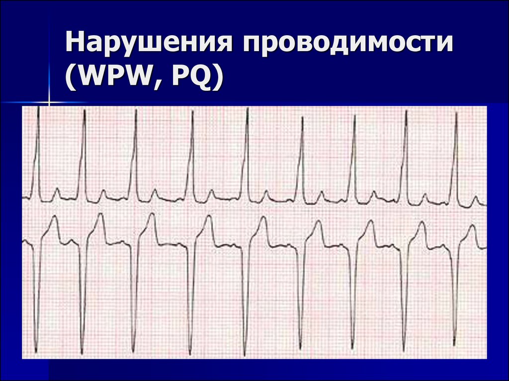 Экг нарушение проводимости. Нарушение проводимости на ЭКГ. Нарушение проводимости сердца на ЭКГ. ЭКГ при нарушении проводимости. Нарушение АВ проводимости на ЭКГ.