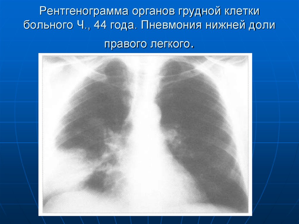 Пневмония в правом легком в нижней доле. Правосторонняя очаговая пневмония рентген. Рентгенография грудной клетки пневмония нижнедолевая. Двухсторонняя очаговая пневмония рентген. Правосторонняя нижнедолевая очаговая пневмония рентген.