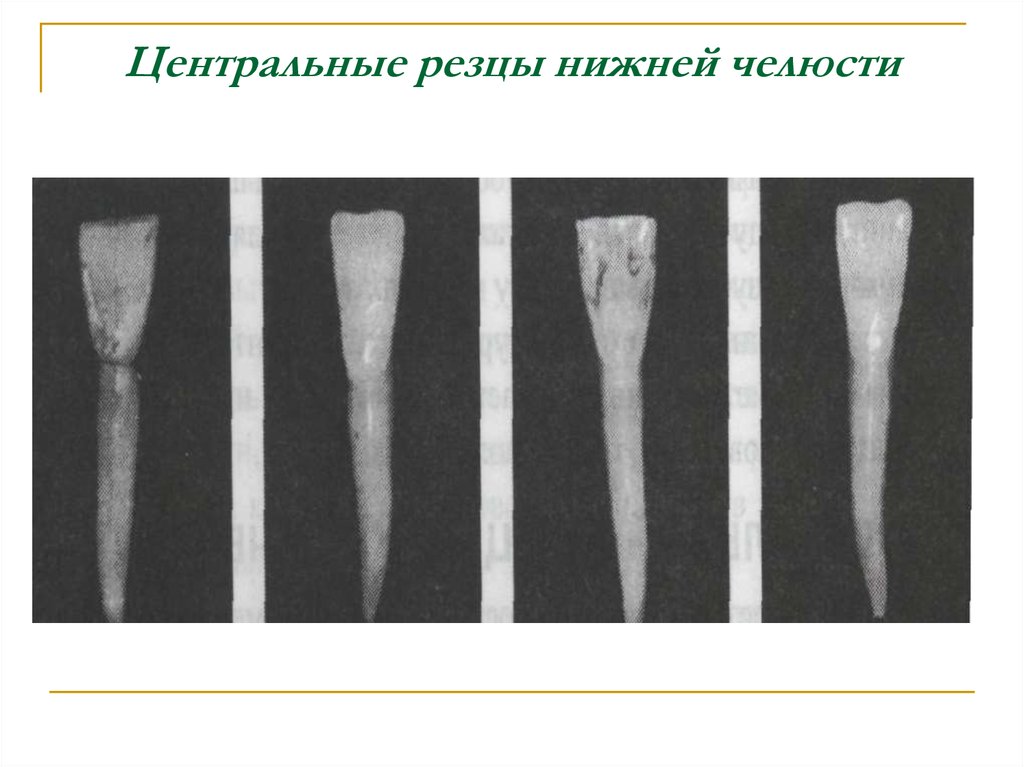 Нижних резцов. Центральный резец нижней челюсти. Нижний Центральный резец нижней челюсти. Центральный резец нижней челюсти анатомия. Первый резец нижней челюсти.