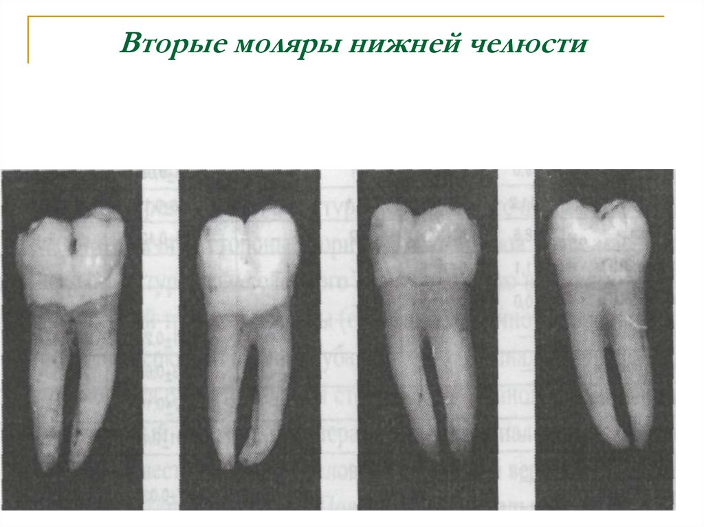 Первый второй моляр нижней челюсти