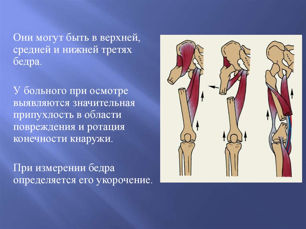 Нижняя треть бедренной кости. Средняя треть диафиза бедра. Перелом верхней и средней трети бедра. Диафизарные переломы бедра. Диафизарные переломы бедренной кости.