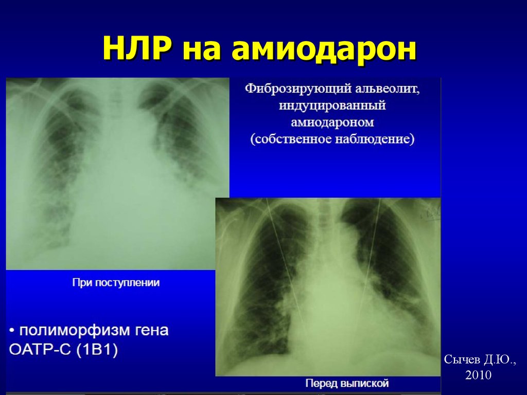 Альвеолиты у детей презентация