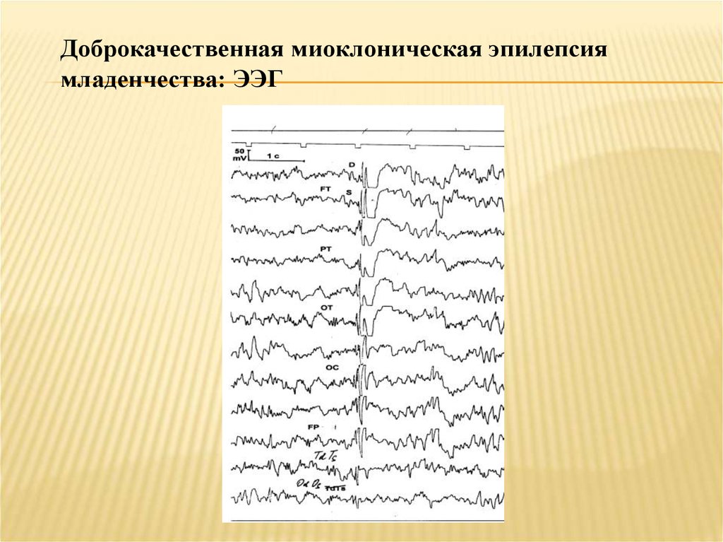 Ээг показывает эпилепсию. ЭЭГ паттерны юношеской миоклонической эпилепсии. Миоклоническая эпилепсия ЭЭГ. Миоклонический приступ на ЭЭГ. ЭЭГ при юношеской миоклонической эпилепсии.