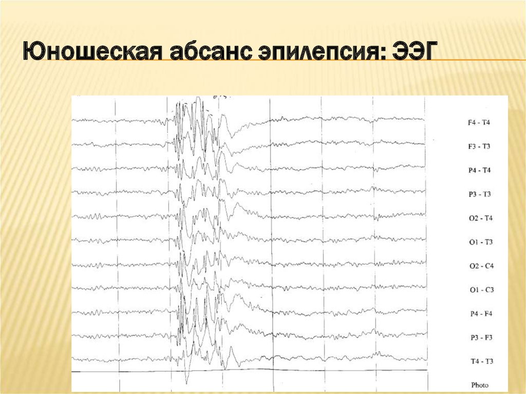 Ээг показывает эпилепсию. ЭЭГ здорового человека и эпилептика. Эпилептический припадок на ЭЭГ. Детская абсанс эпилепсия ЭЭГ критерии. Эпиактивность на ЭЭГ.