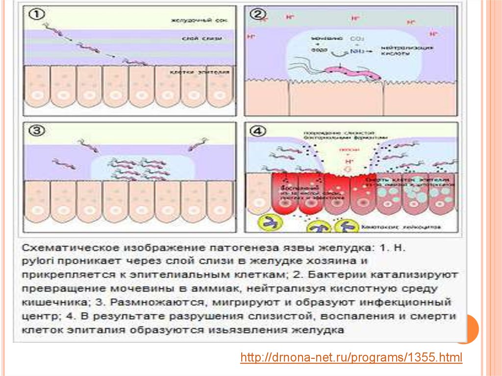 Язвенная болезнь желудка патофизиология презентация