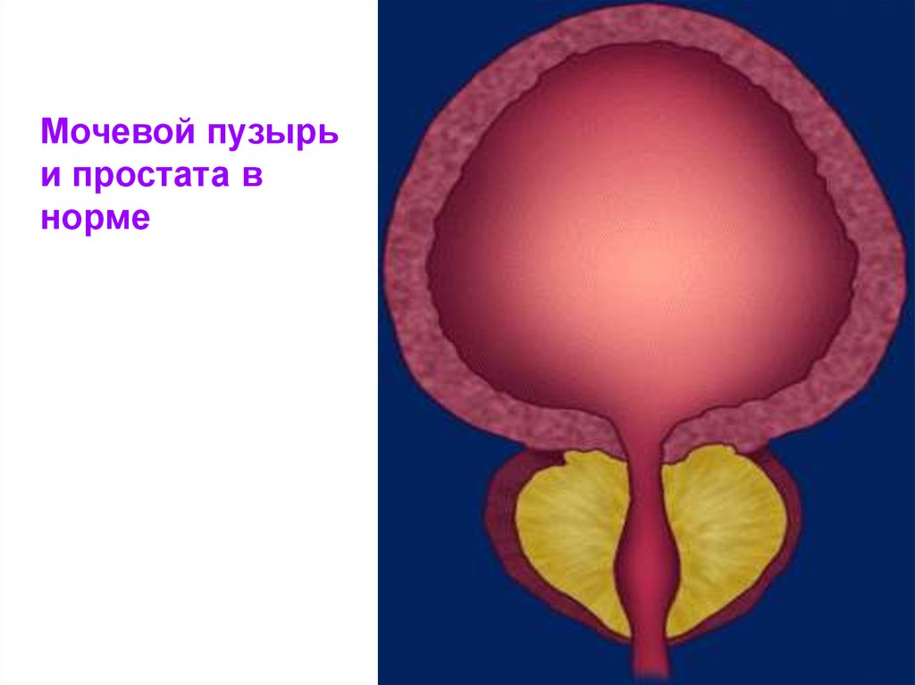 40 гиперплазия предстательной железы. Гиперплазия мочевого пузыря. Гиперплазия предстательной железы. Гиперплазия стенки мочевого пузыря.