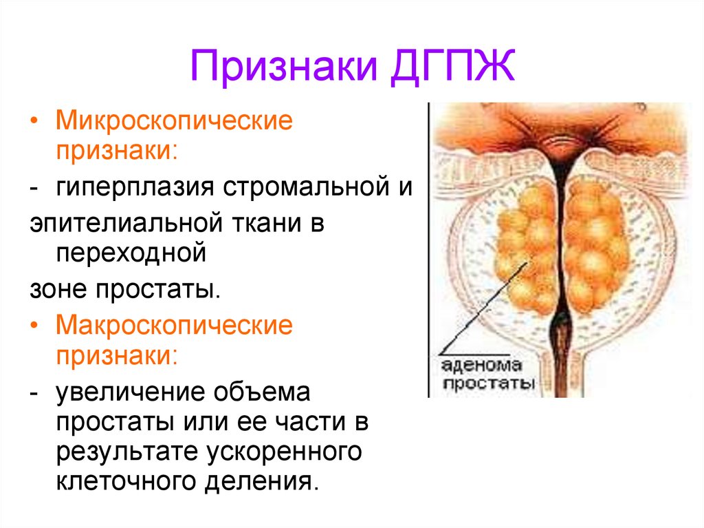 Стромальная гиперплазия предстательной железы