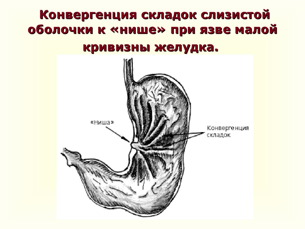 12 желудков. Язва малой кривизны желудка схема. Пенетрирующая язва малой кривизны желудка схема. Язвенная болезнь желудка малой кривизны. Конвергенция складок при язве желудка рентген.