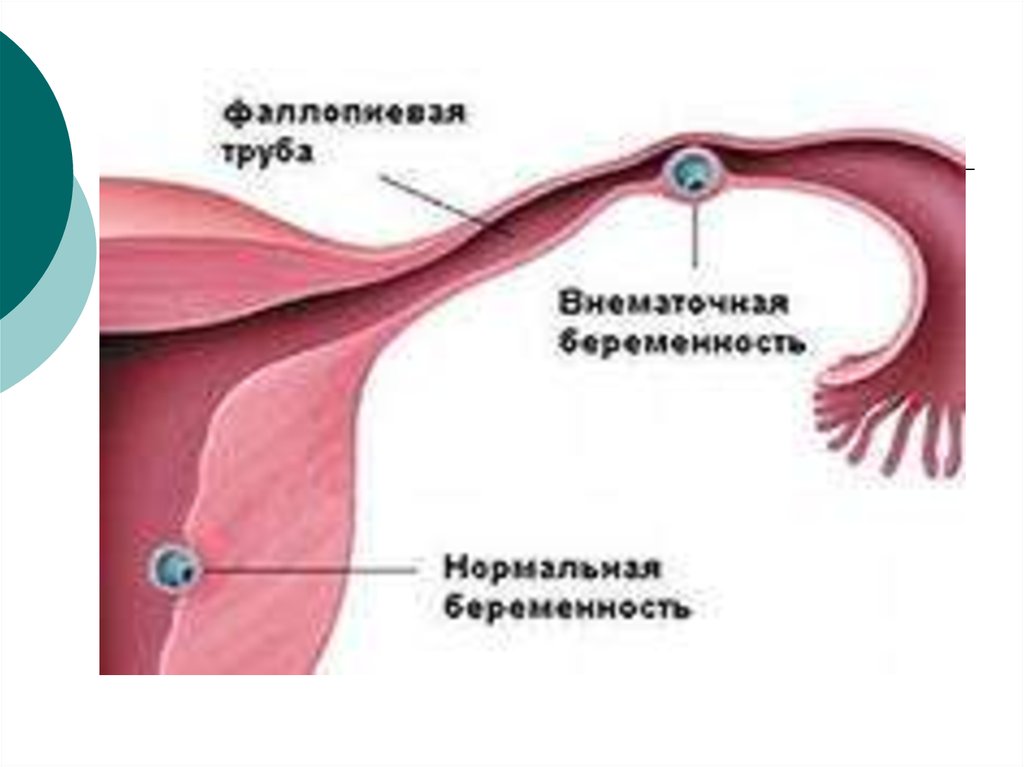 Беременность после внематочной отзывы. Внематочная беременность. Fallopian tubes. Фаллопиевые трубы.