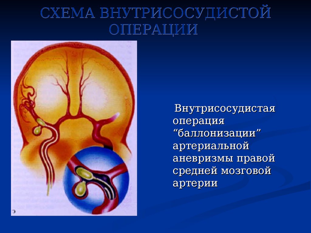 Аневризма сонной артерии что это. Аневризма средней мозговой артерии. Средняя мозговая артерия. Аневризма правой средней мозговой артерии. Средняя мозговая артерия операция.
