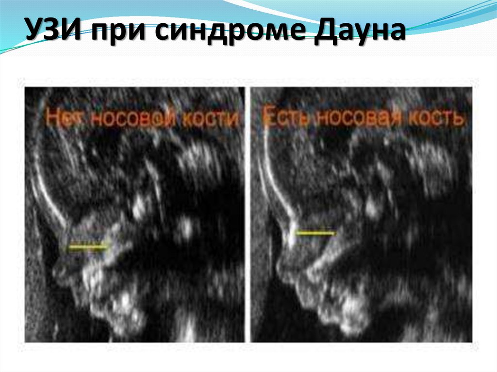 На узи видно дауна. УЗИ плода с синдромом Дауна. Гипоплазия носовой кости.