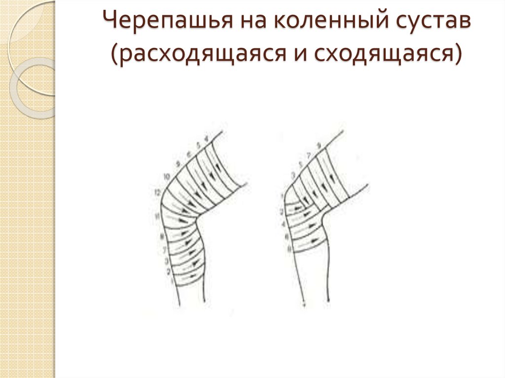 Черепашья расходящаяся повязка на коленный сустав. Черепашья сходящаяся на коленный сустав повязка. Черепашья сходящаяся на локтевой сустав повязка. Черепашья повязка сходящаяся и расходящаяся алгоритм. Черепашья повязка на коленный сустав сходящаяся показания.