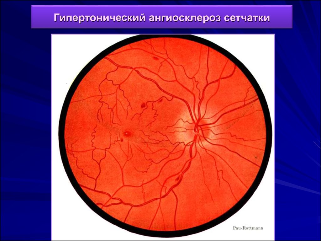 Сужение сосудов глаз. Ангиосклероз сетчатки. Ангиопатия сетчатки глаза ou. Гипертензивная ангиопатия сетчатки. Факосклероз ангиопатия сетчатки глаз.