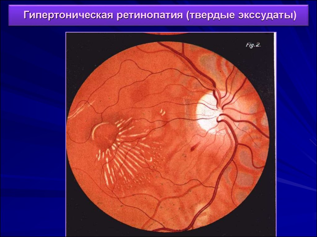 Гипертоническая ангиопатия обоих глаз. Гипертоническая ретинопатия глазное дно. Гипертоническая нейроретинопатия глазное дно. Гипертоническая ангиопатия и ретинопатия. Ангиоспастическая ретинопатия.
