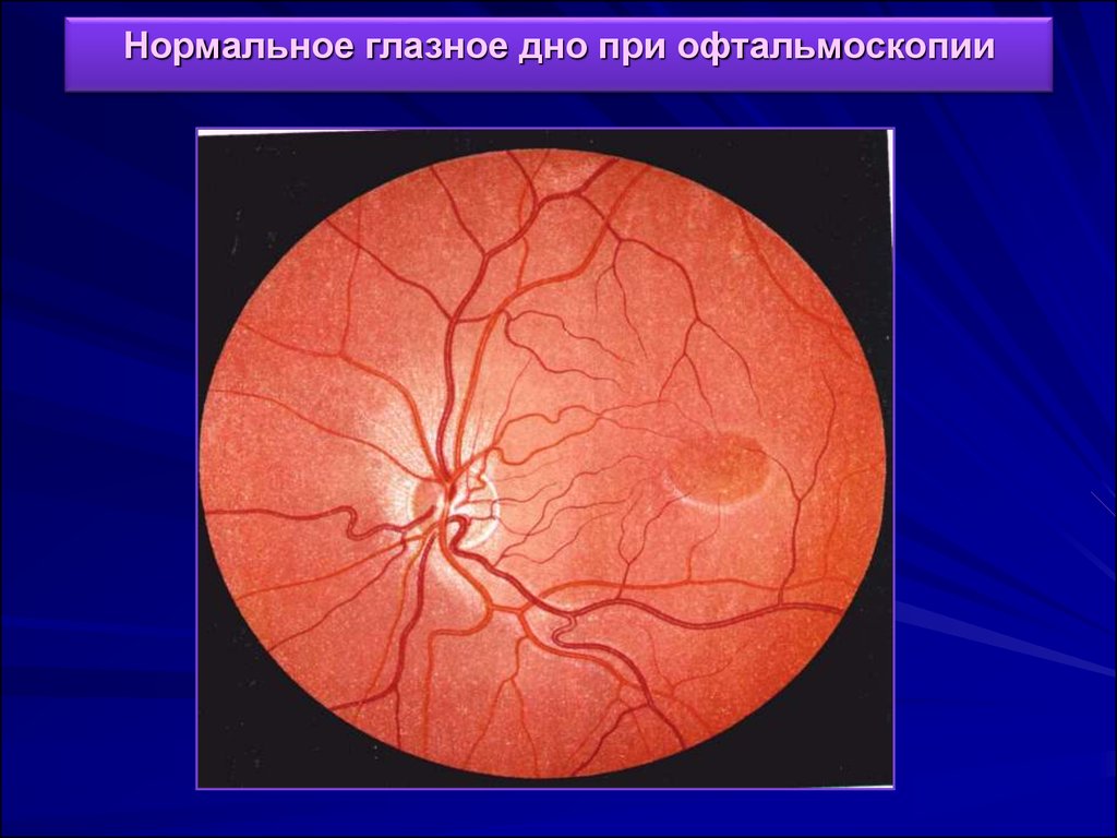 Норма глаз. Нормальное глазное дно. Нормальная картина глазного дна.